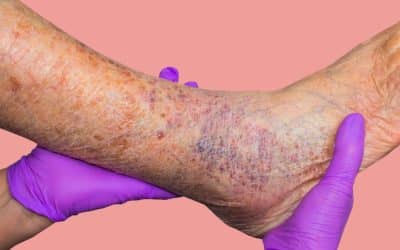 Varicose Veins and Herbal Remedies for Pain, Swelling, and Comfort